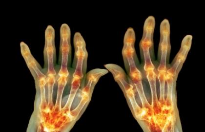 Arthritis - Types, Causes, Treatment